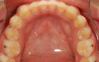 Overbite correction with a retainer lower after