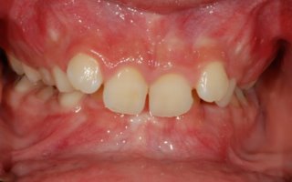 Overbite Correction Front Teeth Before