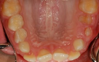 Overbite correction with a retainer upper before