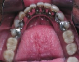 Picture after partial dentures were placed