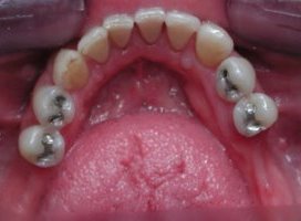 Picture before partial dentures were placed