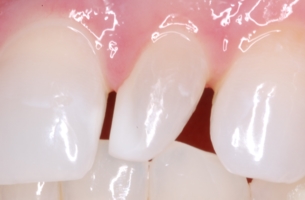 Peg lateral incisor before being restored with a porcelain laminate