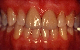 Teeth gap restored with porcelain laminates
