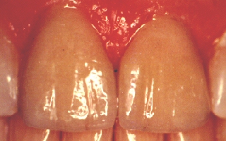 Teeth gap restored with porcelain laminates