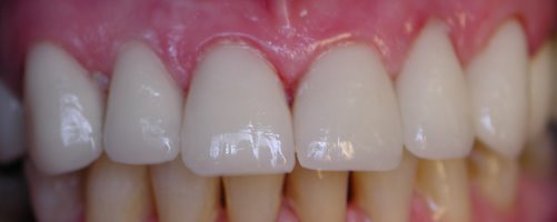 Chipped teeth after being restored with porcelain laminates