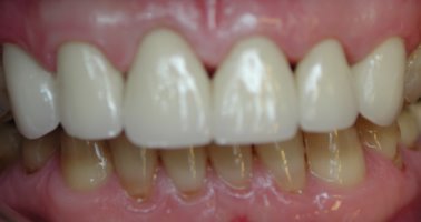 Chipped teeth after being restored with porcelain laminates