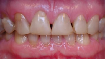 Ugly teeth before being restored with porcelain laminates