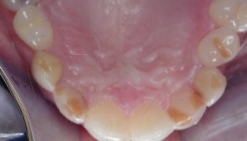 Teeth before porcelain laminates and dental bridges