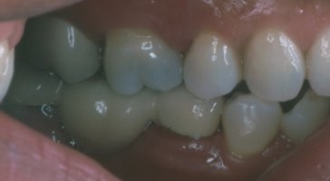 After placement of a bridge