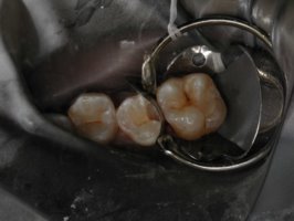 A cavity ready to be filled with a tooth-colored filling (composite filling)