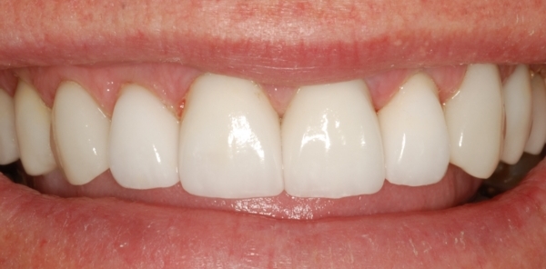 Porcelain Crowns Restoring a Worn Smile
