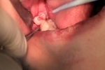 Wisdom Teeth Extraction Video