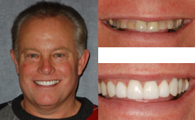 Porcelain Crowns Done By a Lawrenceville Dentist