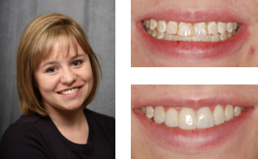 Cosmetic Bonding by a Dentist in Lawrenceville
