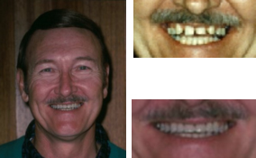 Orthodontics and Bridges By a Dentist in Lawrenceville GA