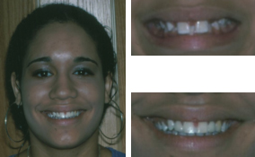 Orthodontics and Bridges By a Dentist in Lawrenceville GA