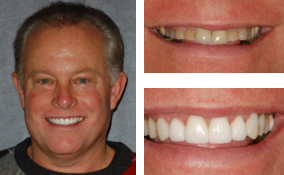 Porcelain Crowns Done By a Lawrenceville Dentist