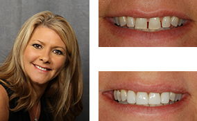 Porcelain Veneers Done By a Lawrenceville Dentist