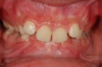 Orthodontics For Bad Overbites - Before