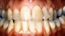 Teeth Bleaching - Before