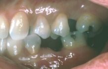 Replacement Of Missing Teeth With Fixed Bridges - Before