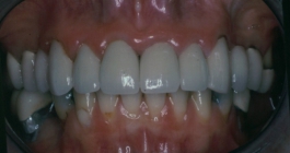 Severe Erosion Corrected With Crowns - After