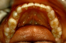 Orthodontics For Crowded Teeth Without Braces - After