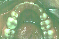 Orthodontics Using Braces - After