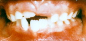 Orthodontics For Crowded Teeth Without Braces Five Years Later - Before