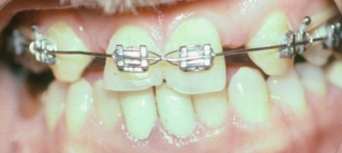 Orthodontics And Fixed Bridgework - Before
