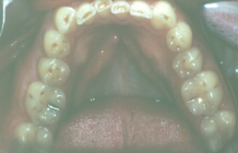 Orthodontics To Create Space To Restore Severely Worn Teeth - Before